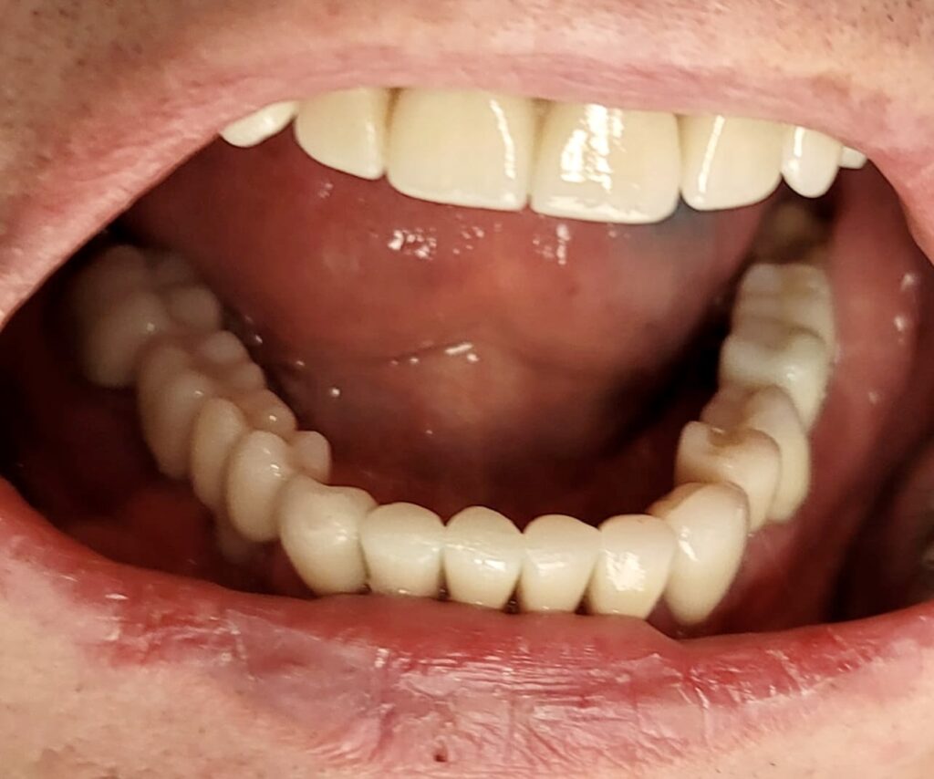praca kombinowana na zębach własnych i na implantach w cyrkonie pelnokonturowym